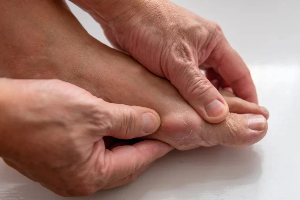 大脚趾痛风的症状和治疗