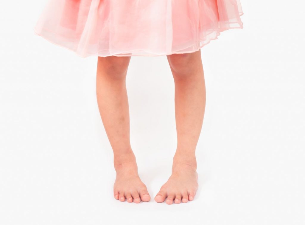 什么是内八字脚？什么是鸽子脚？海峡足科诊所