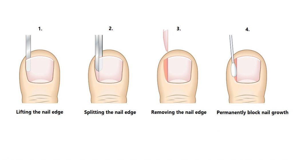 What is Partial Nail Avulsion? - Straits Podiatry